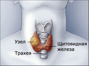 Лечение гиперплазии щитовидной железы 1, 2, 3 степени, признаки заболевания